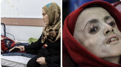 الطفل في الصورة بالفعل يعاني من شلل دماغي لكن سوء التغذية وعدم توفر العلاج أوصله لهذا الحال.