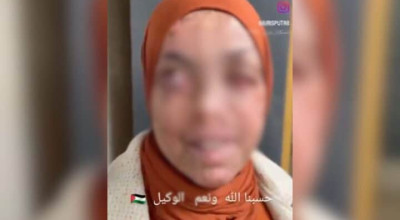 فيديو لفتاة مغربية مصابة بمرض &#8220;الجلد المصطبغ&#8221; متداولٌ بأنه لفلسطينية أصيبت خلال الحرب في غزة