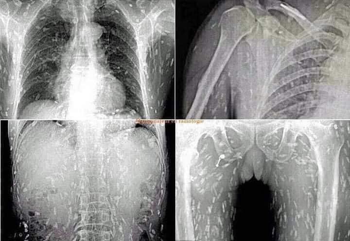 حقيقة صور الأشعة لمريض تَسبَب "السوشي" في إصابته بديدان في جميع أنحاء جسده